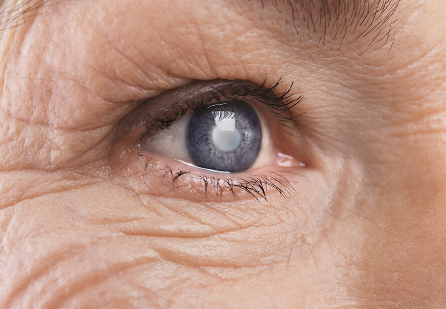 Closeup of a Cataract in an Eye