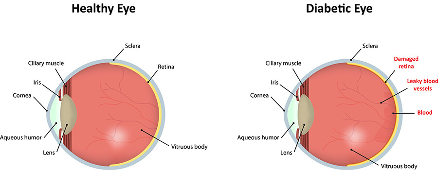 Chart Illustrating a Healthy Eye Vs a Diabetic Eye