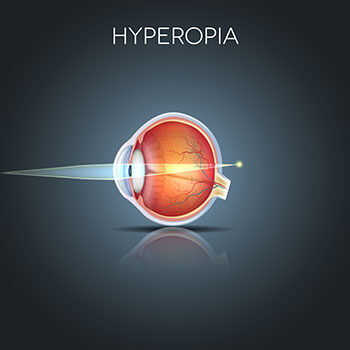 Chart Showing How Hyperopia Affects an Eye