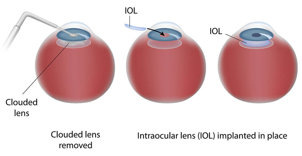 Chart Illustrating the IOL Insertion Process
