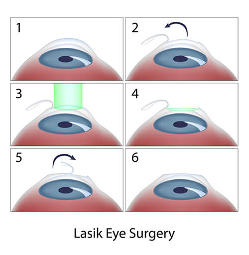 Chart Illustrating the Steps of LASIK Surgery
