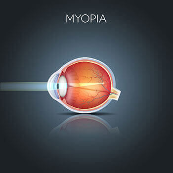 Chart Showing How Myopia Affects an Eye