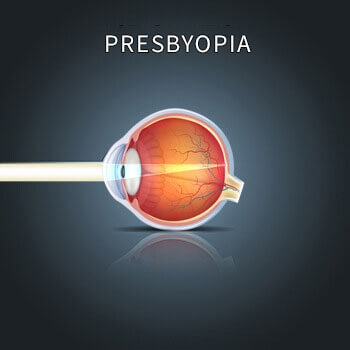 Chart Showing How Presbyopia Affects an Eye
